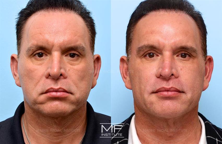 Before & After contouring for youthfulness face shape