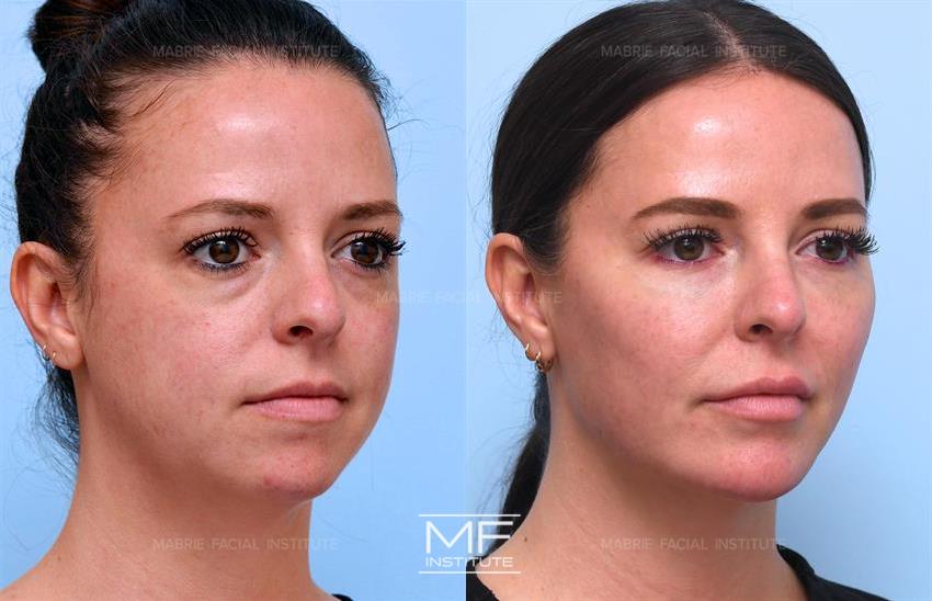 Before & After contouring for pleasing face shape