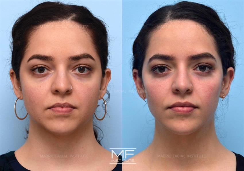 Before & After contouring for heart face shape