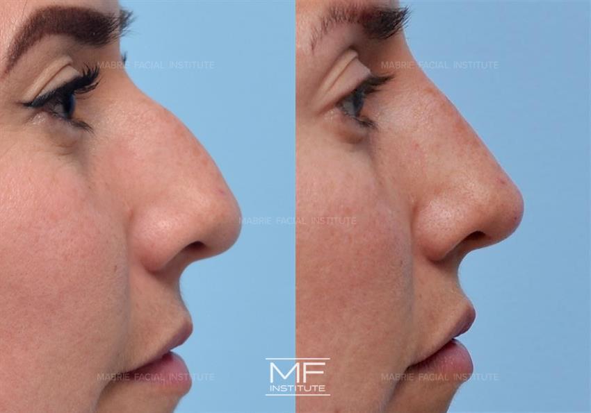 Before & After contouring for nose-nasal-hump face shape