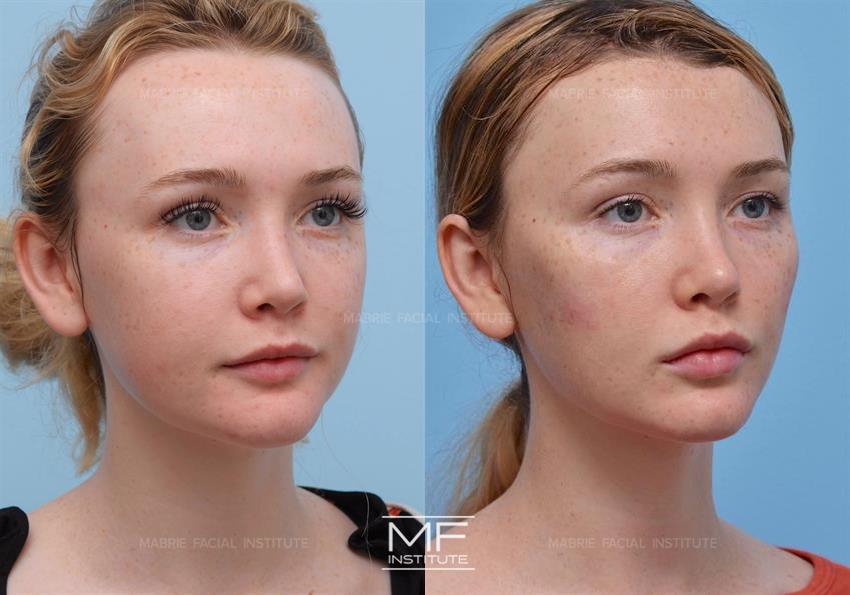Face Contouring for Younger Patients: Improving the Jawline and