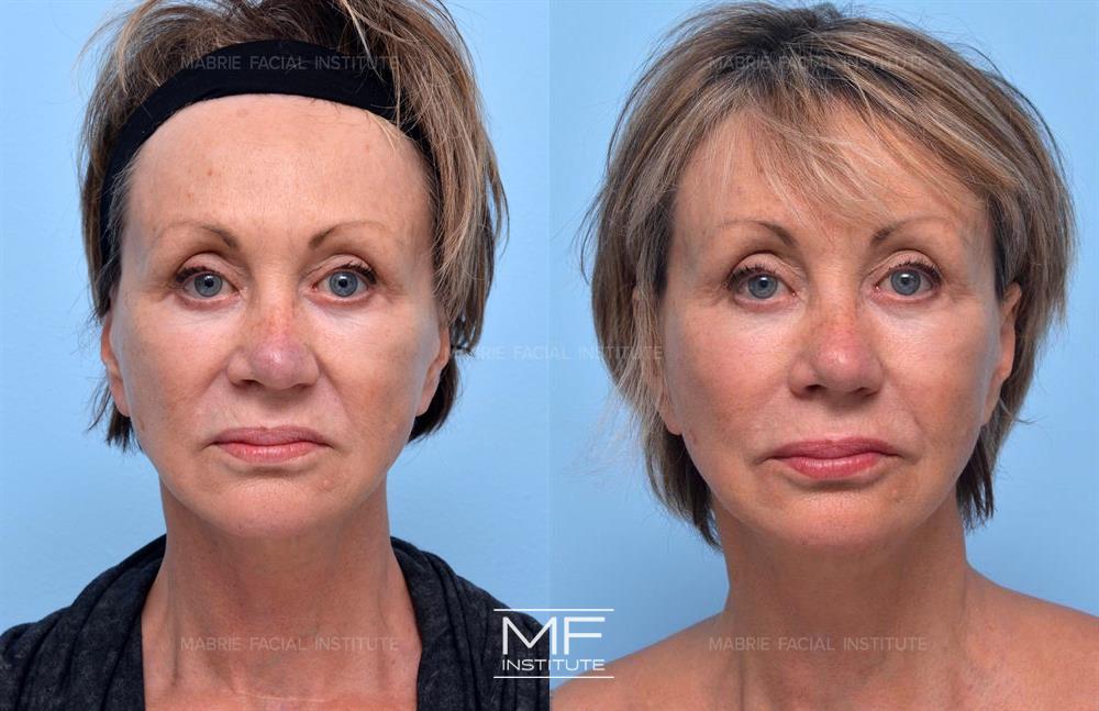 Before and After BOTOX for Nasolabial Folds case #485