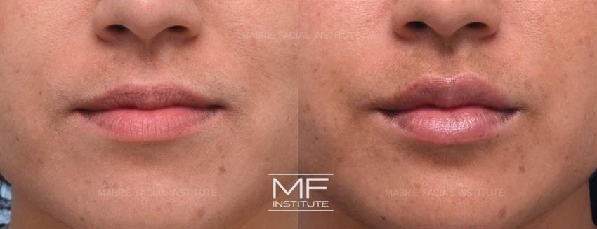 Before & After contouring for lip-filler-candidates face shape