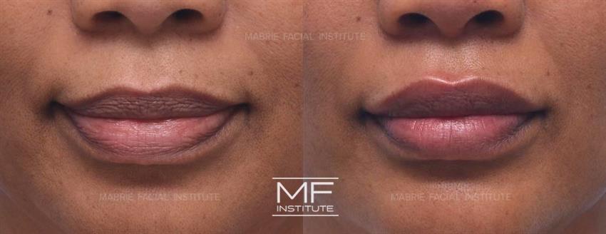 Before & After contouring for Lip Filler Before and After Photos face shape