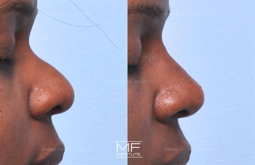 Before & After contouring for nose-nasal-hump face shape