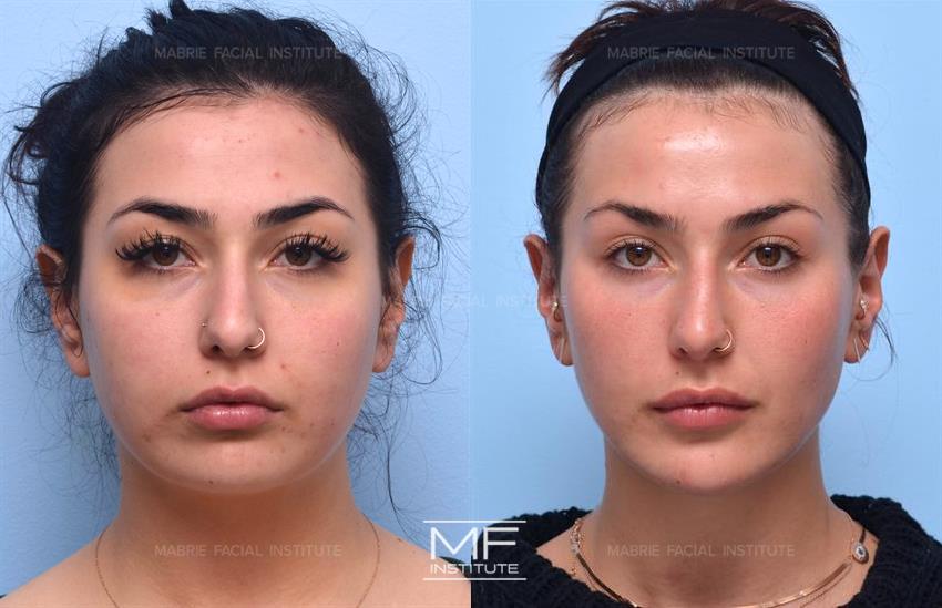 Before & After contouring for pleasing face shape