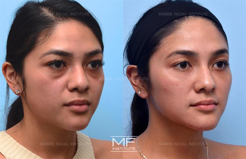 Full Face Contouring Before & After Photo Gallery