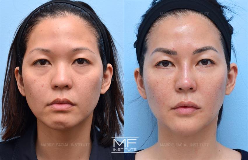 Before & After contouring for youthfulness face shape