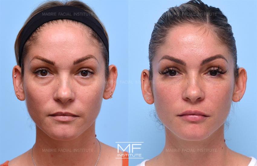Before & After contouring for Tear Trough Filler face shape