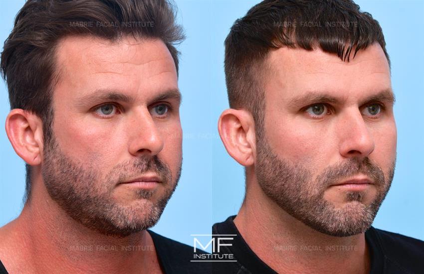 Before & After contouring for Straighter Jaw face shape