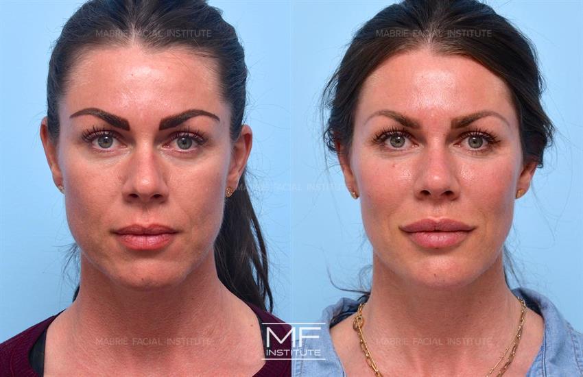 Before & After contouring for athletic face shape