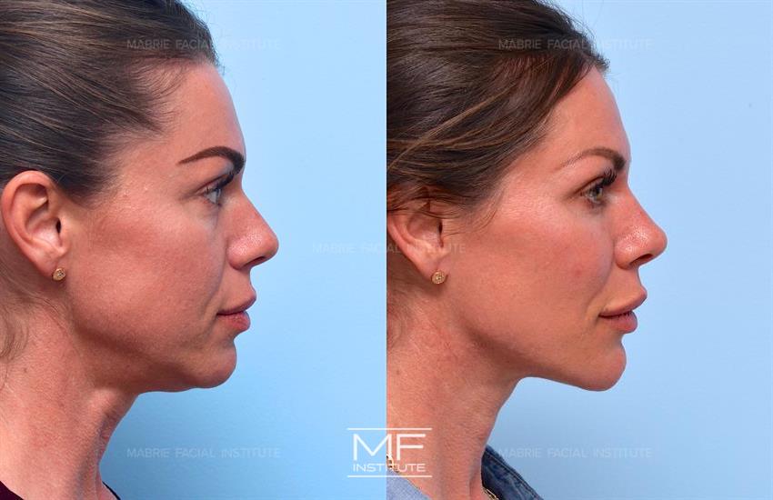 Before & After contouring for athletic face shape