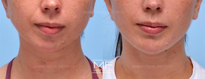 Before & After contouring for strong face shape