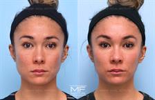 BOTOX® for Masseter & Jaw Before & After Photo Gallery, San Francisco, CA