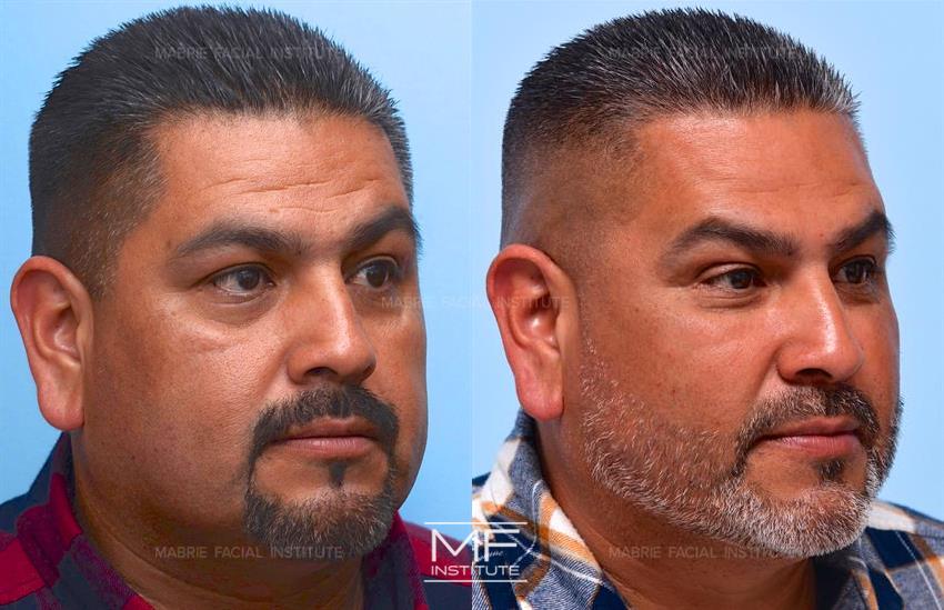 Before & After contouring for Midface Rejuvenation for Men face shape