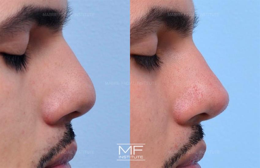 Before & After contouring for nose-bulbous-tip face shape