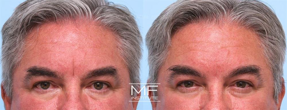 before and after botox and fillers for deep forehead wrinkles case #655