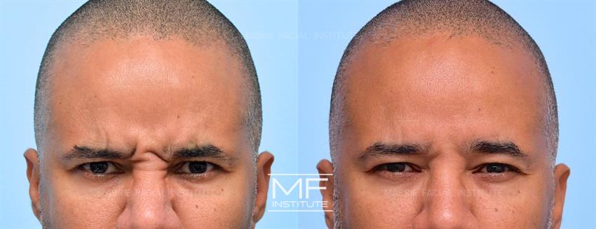 Before & After contouring for Upper Face BOTOX for Men face shape