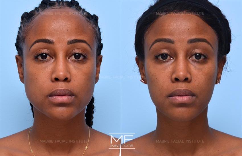 Before & After contouring for square face shape