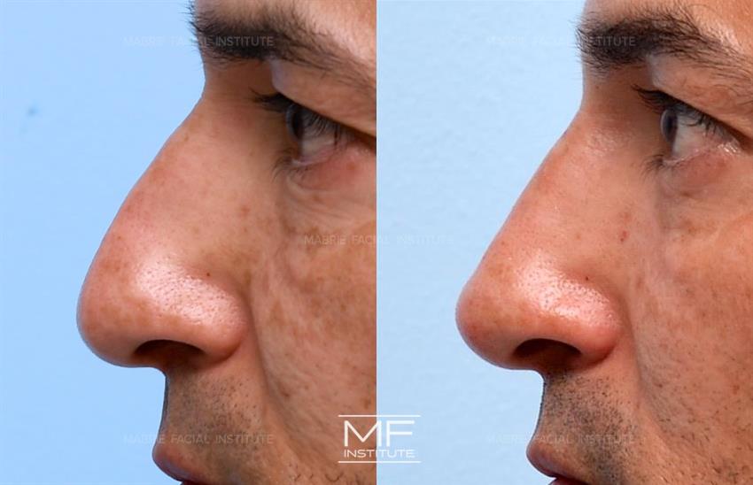 Before & After contouring for Non Surgical Nose Job face shape