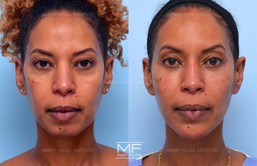 Before & After contouring for oval face shape
