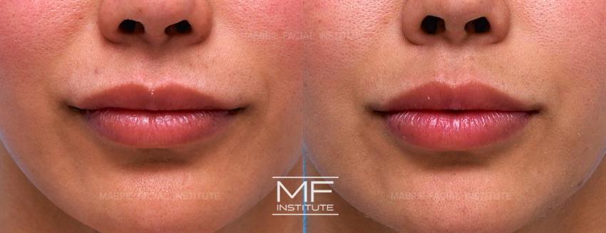 Before & After contouring for Dissolving Lip Filler face shape