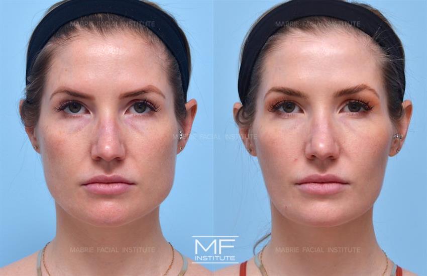 Before & After contouring for square face shape