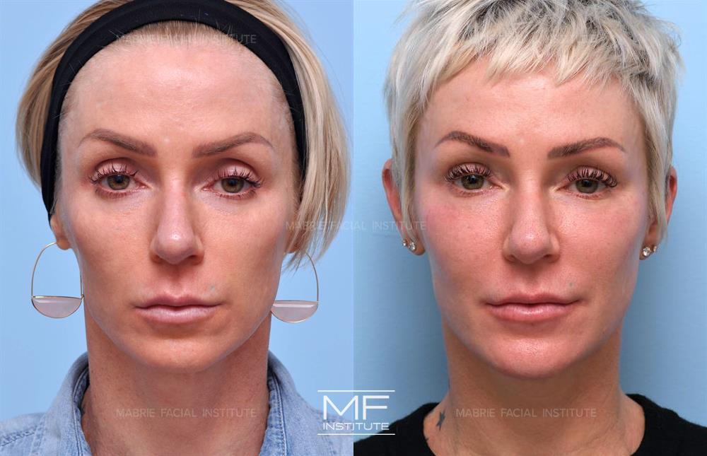 Jawline Filler for Definition & Contour (Updated 2023) – Mabrie Facial  Institute