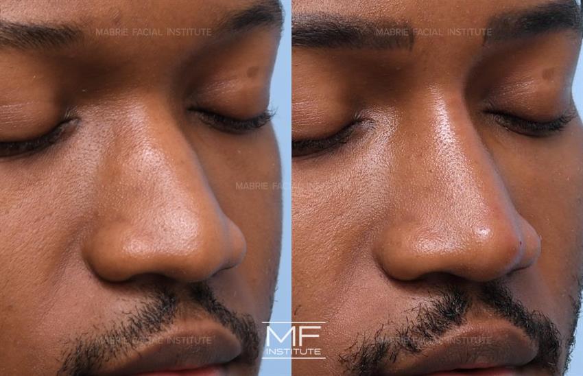 Before & After contouring for example face shape