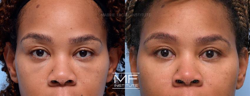 Before & After contouring for Dissolving Filler Under the Eyes face shape