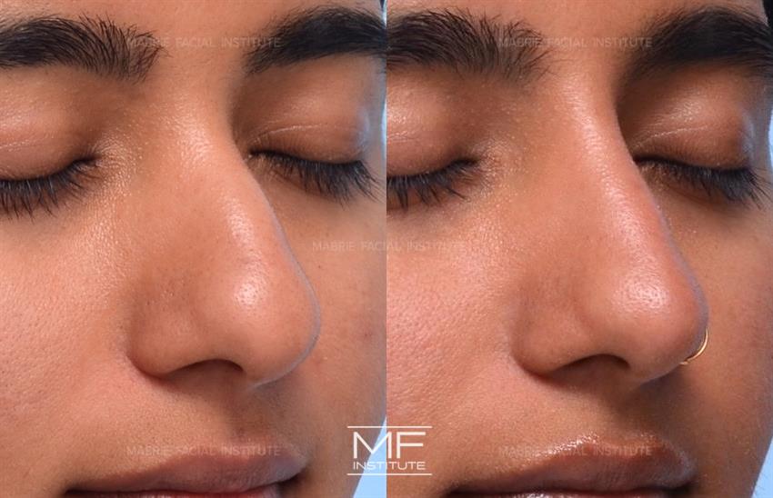 Before & After contouring for nose-droppy-tip face shape