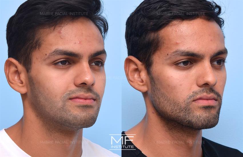Before & After contouring for Jaw Angle face shape