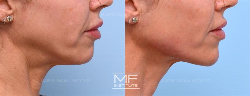 Before & After Photos of Non surgical Facial Rejuvenation