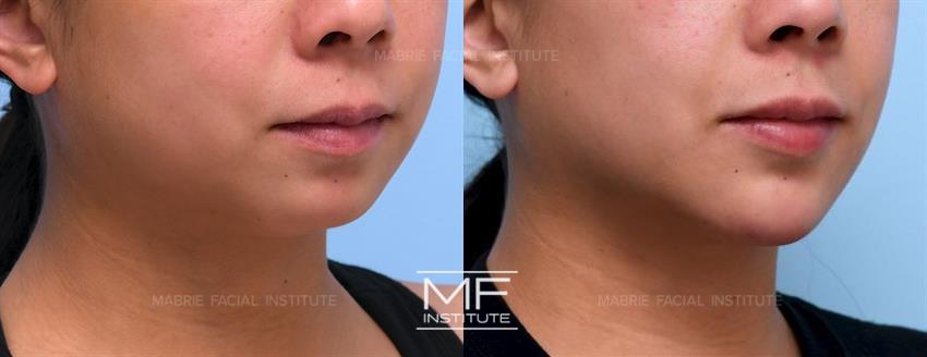 Before and After Marionette Lines Filler: A Photo FAQ