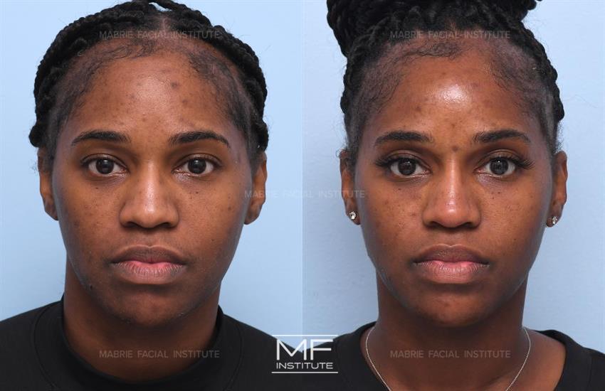 Before & After contouring for high face shape