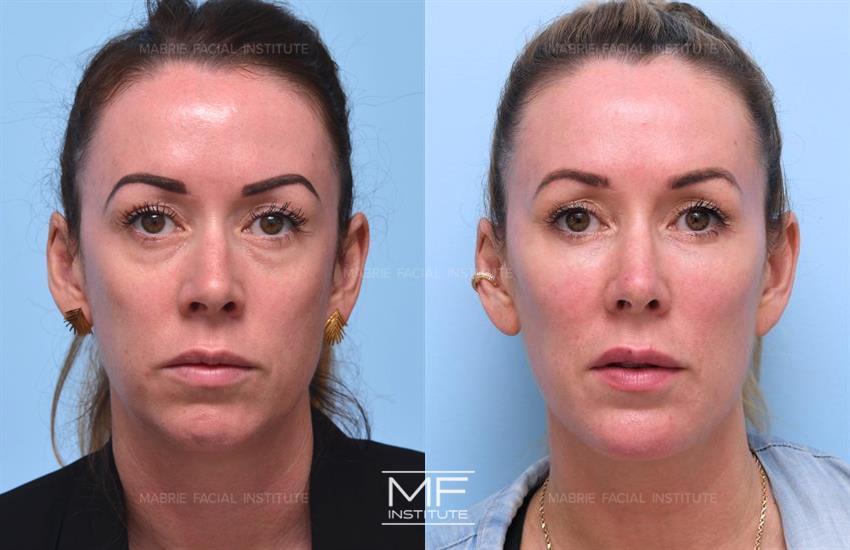 Before & After contouring for Tear Trough Filler face shape