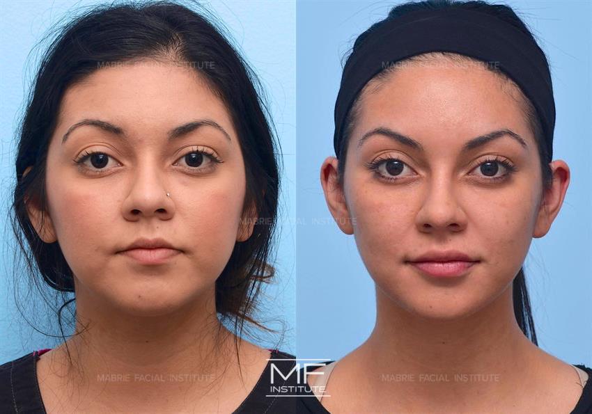 Before & After contouring for round face shape