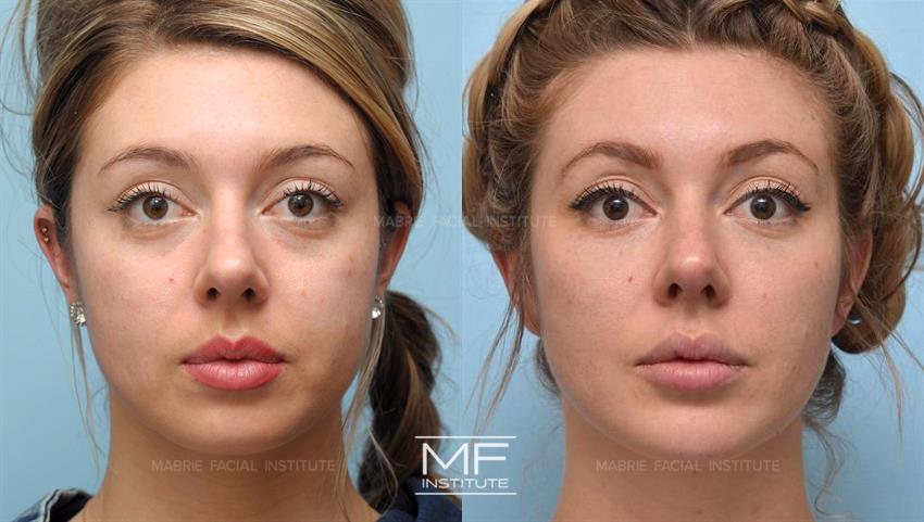 Before & After contouring for round face shape
