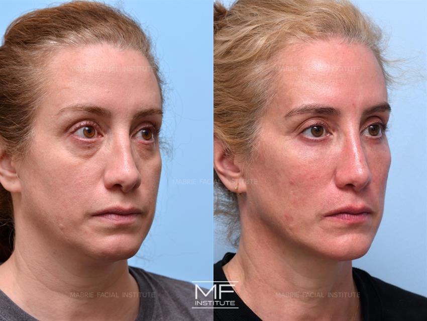 Before & After contouring for high face shape