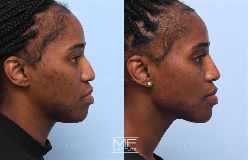 Nonsurgical Jawline Contouring Charlotte, NC