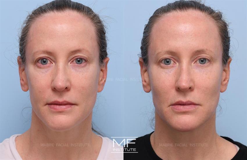 Before & After contouring for symmetry face shape