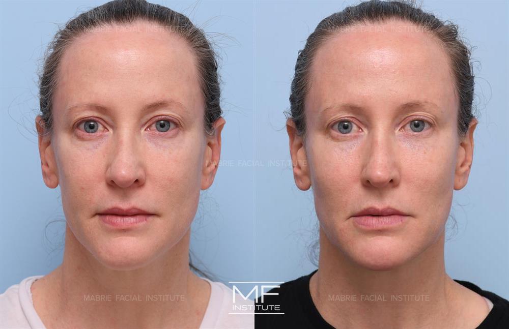 Jawline Filler for Definition & Contour (Updated 2023) – Mabrie Facial  Institute