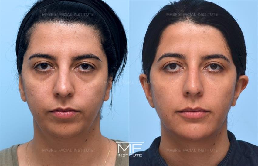 Forget Buccal Fat Removal: Start With BOTOX® for Face Slimming (Updated  2023) – Mabrie Facial Institute