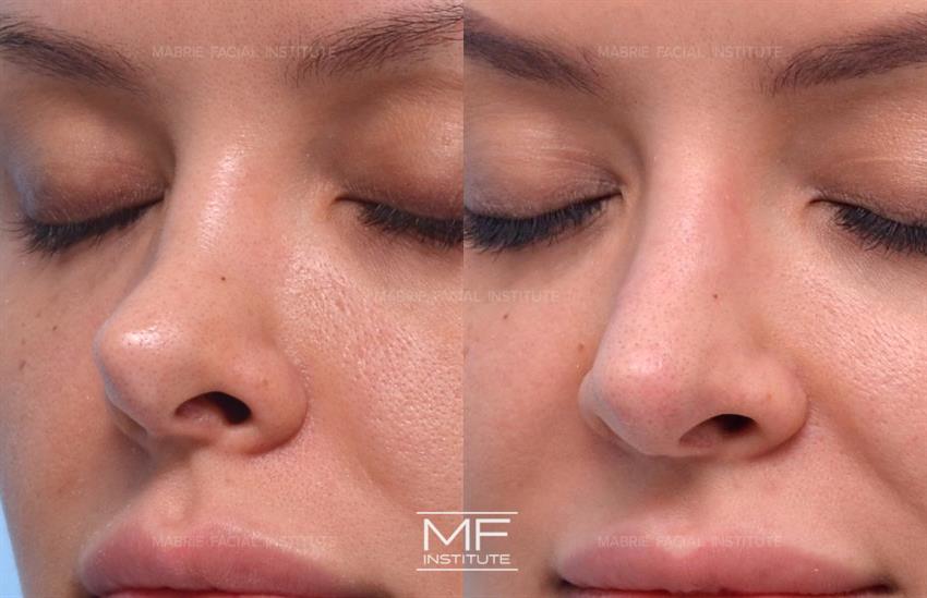 Before & After contouring for MFI Real Non Surgical Rhinoplasty Results face shape