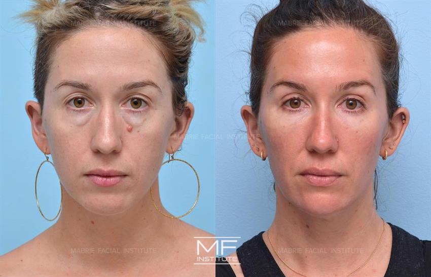 Before & After contouring for Tear Trough Filler face shape