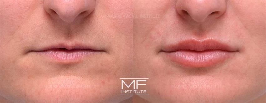 Before & After contouring for lip-filler-candidates face shape
