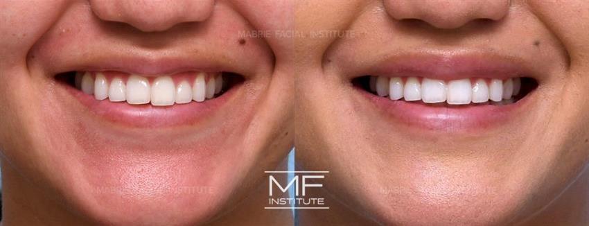 Before & After contouring for botox-lip-flip face shape