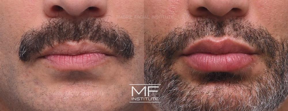 Before and After BOTOX & Filler for Deep Forehead Wrinkles case #826