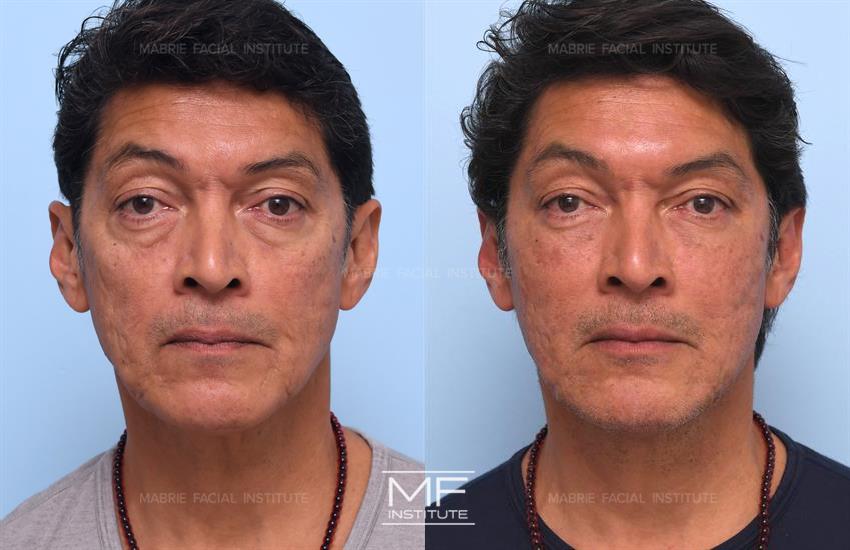 Before & After contouring for Under Eye Filler for Men face shape
