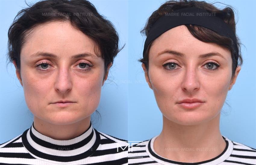 Before & After contouring for Masseter BOTOX face shape